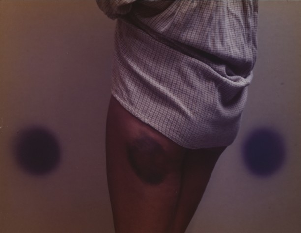 Bonnie's Bruise, Buffalo, NY