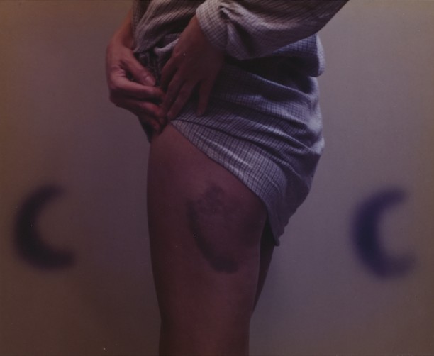 Bonnie's Bruise (Later Version), Buffalo, NY